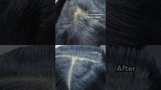 Nits lice treatment 💯 result just 2 hrs Chennaiheadlicetreatmenthairliceliceremovallicetreatment [upl. by Airotnes]