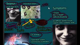 Tetanus Disease Lockjaw  signs and symptoms prevention treatment and prognosis [upl. by Porter992]