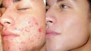 How To Remove Acne Marks amp Acne Scars [upl. by Aret]