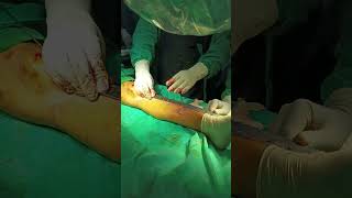 Tibia nail befor distal screw all then procimal femar and tibia all nailing [upl. by Drucilla]