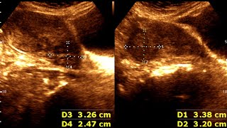 Three cases of Leiomyoma Uterus  Abnormal Uterine Bleeding  sonographic prediction [upl. by Landre956]