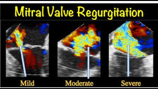 Mitral valve regurgitation  How to Diagnose Mitral Regurgitation [upl. by Nagey]