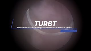 TURBT  Transurethral Electrosurgical Resection of Bladder Tumor [upl. by Cran238]