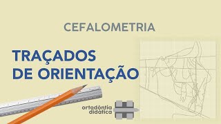 Cefalometria  Traçados de Orientação [upl. by Guyon]