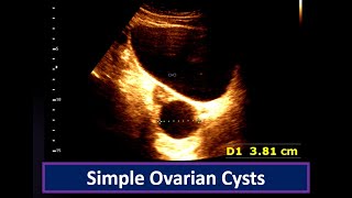 Understanding Simple Ovarian Cysts Ultrasound Findings  Ovarian Cyst  Simple follicular cyst [upl. by Alf303]