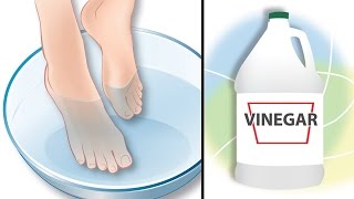 Dip Your Feet In Vinegar For This AllNatural Benefits [upl. by Sivolc]