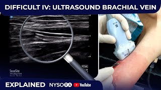 DIFFICULT IV ULTRASOUND GUIDED BRACHIAL VEIN [upl. by Benedikta]