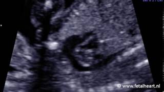 Fetal heart Academy  DORV Fallot 1 aortic arch [upl. by Blackburn]