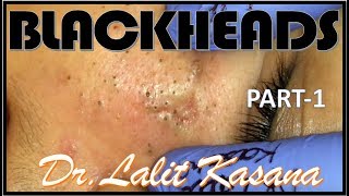 BLACKHEAD REMOVAL PART 1 BY DRLALIT KASANA [upl. by Drewett]