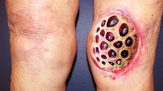 Top 100 Trypophobia Disease Photos Ever NSFE [upl. by Ailema522]