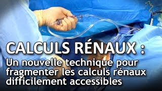 Calculs rénaux  un nouveau traitement pour les calculs difficiles à atteindre [upl. by Phillie]