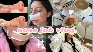 I GOT A RHINOPLASTY IN MEXICO [upl. by Wilen]