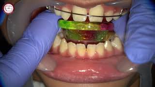 step by step Growth modification by activator in orthodontics by Dr Amr Asker [upl. by Anetta]