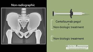 A OneYear PlaceboControlled Study in NonRadiographic Axial Spondyloarthritis [upl. by Delphinia346]