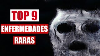 TOP 9 ENFERMEDADES MÁS RARAS DEL MUNDO [upl. by Aiello]