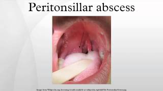 Peritonsillar abscess [upl. by Analak662]