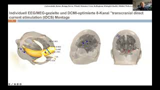 Bioelektromagnetismus Anwendung in d prächirurgischen EpilepsieDiagnose C Wolters Uni Münster [upl. by Mohun]