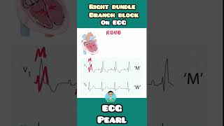 RBBB Right Bundle Branch Block on ECG  quick mnemonic for USMLE NEET PG INICET NCLEX mednotes [upl. by Cori316]