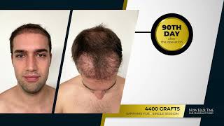 Hair Transplant Turkey Before amp After  8 Months Results [upl. by Icul]