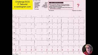 Rythme sinusal avec extrasystoles  Algorithme utile  Quiz ECG Dr Taboulet [upl. by Keg]