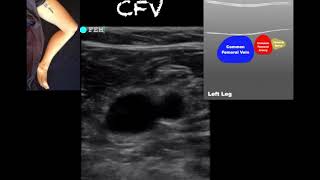 POCUS  Lower Extremity Deep Venous Thrombosis DVT  Updated [upl. by Lisab139]