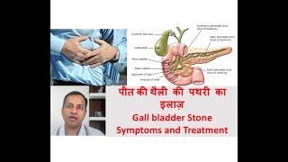 Gall bladder stone symptoms treatment in Hindi By Dr Vikas Singla [upl. by Yespmed369]