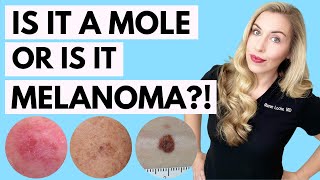 Is It A Mole or Melanoma This Might Save Your Life  Dermatologist Tips [upl. by Nelrac643]