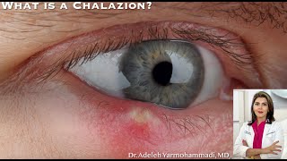 What is a Chalazion quotWhat is that red bump on my eyelidquot [upl. by Zaremski]