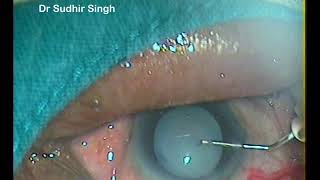 Capsulorhexis In Different Situations By Dr Sudhir SIngh [upl. by Aehs141]