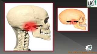 ¿Qué es el síndrome de disfunción temporomandibular ATM [upl. by Aerbma338]