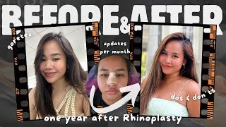 My Rhinoplasty Journey EP3 1 year update since my operation journey to recovery  Milleyjn Aira [upl. by Ezekiel]