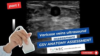 Part 1 Varicose veins ultrasound assessment GSV anatomy assessment [upl. by Lam]