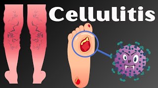 Cellulitis Causes Signs amp Symptoms Pathophysiology Diagnosis and Treatment [upl. by Trinia]