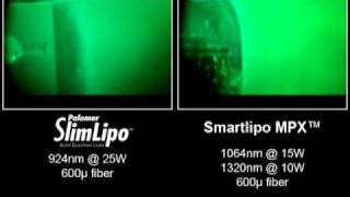 Video of Laser Liposuction Comparing SlimLipo vs SmartLipo and Lipotherme [upl. by Elmajian]