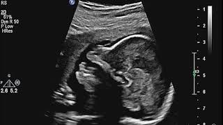 Fetus 20 weeks fetal anemia suspected lissencephaly hepatomegaly echogentic dilated bowel [upl. by Nagy537]