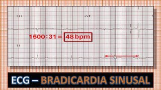 ECG  Eletrocardiograma com Bradicardia Sinusal [upl. by Amble]