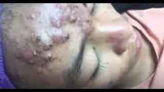 The Most Extreme Blackhead Popping Videos of 2023  satisfying  blackheads  pimple [upl. by Nitaf]