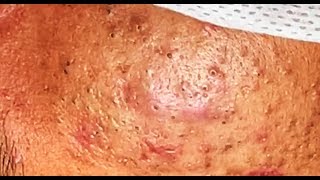 how to remove acne Blackheads and whiteheads it stay with him 5 years ago  Lymy nature 4 [upl. by Ainocal590]