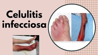 ERISIPELA y CELULITIS INFECCIOSA ¿ES CONTAGIOSA ¿Qué secuelas deja la celulitis que debo hacer [upl. by Nimesay]