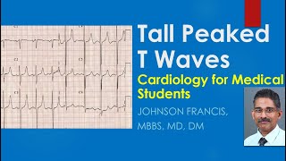 Hyperkalemia  Peaked TWaves  and ECG Recognition [upl. by Suelo757]