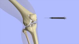 Knee Joint Injection [upl. by Gibbon940]