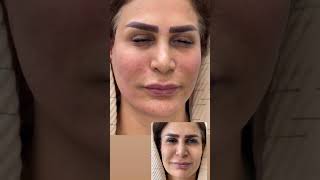 FullFace Lift and Removal of Smile and Marionette Lines with 5cc Filler Injection facelift lift [upl. by Knowlton]