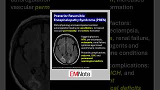 Posterior Reversible Encephalopathy Syndrome PRES doctor medical nursing [upl. by Ynots]