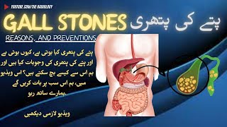 gallstones Unveiled Understanding Causes Symptoms and Treatment Options theradiology5817pain [upl. by Lawan32]