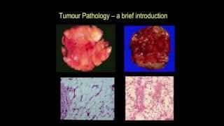 Tumour pathology  a brief introduction part III [upl. by Raffo]