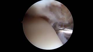 Ankle Arthroscopy Impingement Debridement SFISM [upl. by Llebanna]