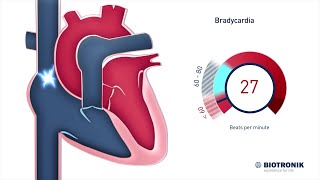 Che cosè una frequenza cardiaca lenta  Animazione medica [upl. by Satsoc]