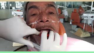 HOW TO RECORD JAW RELATIONS IN COMPLETE DENTURE PATIENT [upl. by Mauri]