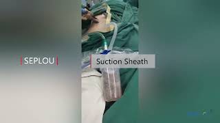 Percutaneous Nephrostomy Sheath Suction Sheath [upl. by Moira]