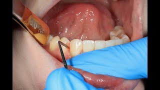 Gum Disease New Treatment Using LASERS amp PRF [upl. by Aikrehs]